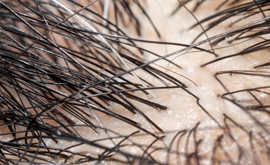 magnified picture of scalp and hair follicles