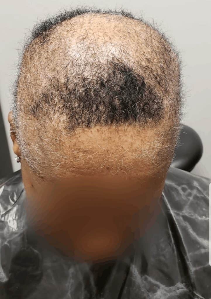 balding black women suffering from hair loss