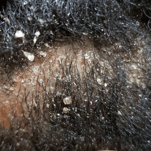 Example of scalp Psoriasis